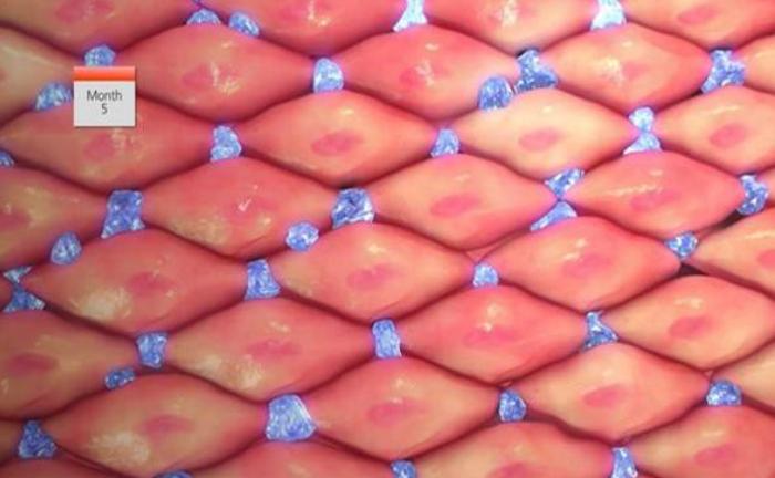 An Analysis of the “Long-lasting Efficacy” of the MiStent Stent