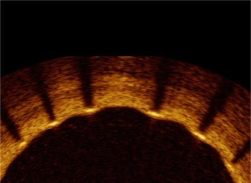 The Clinical Research of Mistent® Coronary Drug Eluting Stent System